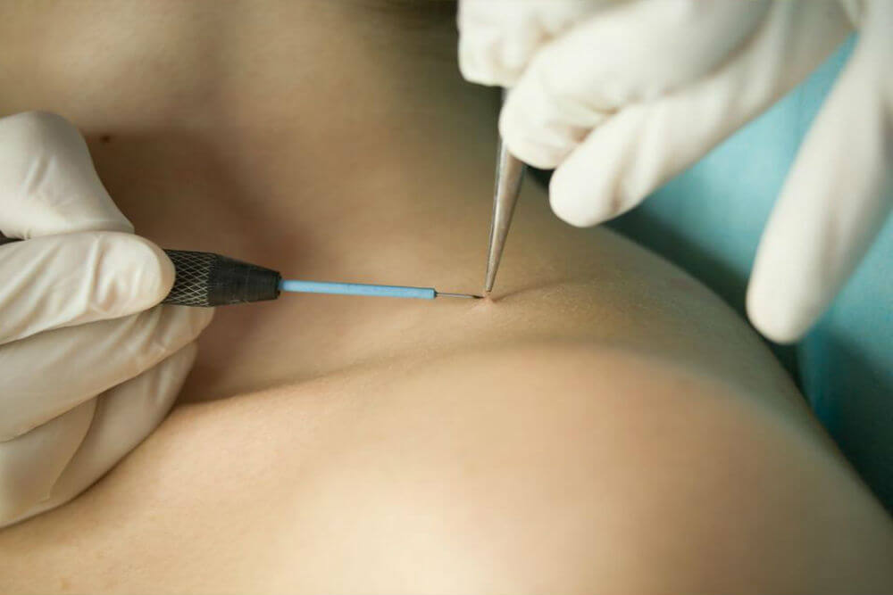 Методы лечения вируса папилломы человека