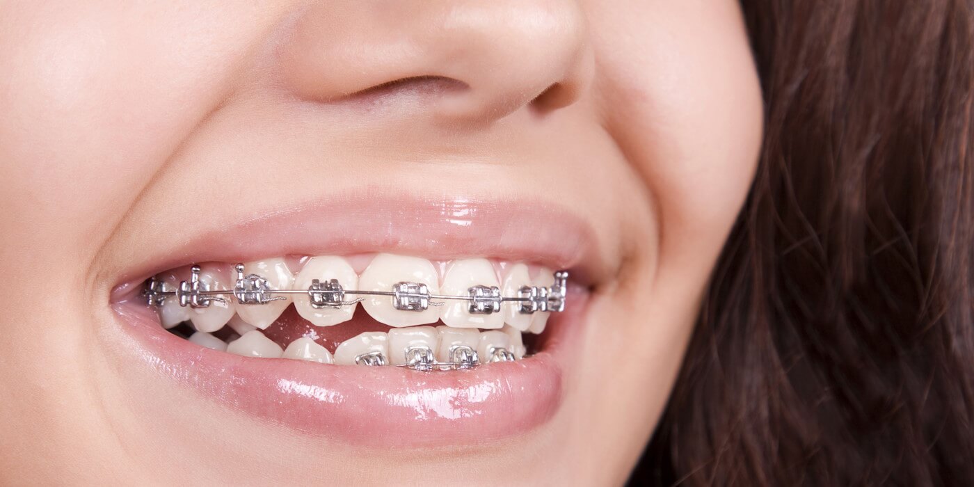 Ортодонтия: Путь к здоровой и красивой улыбке